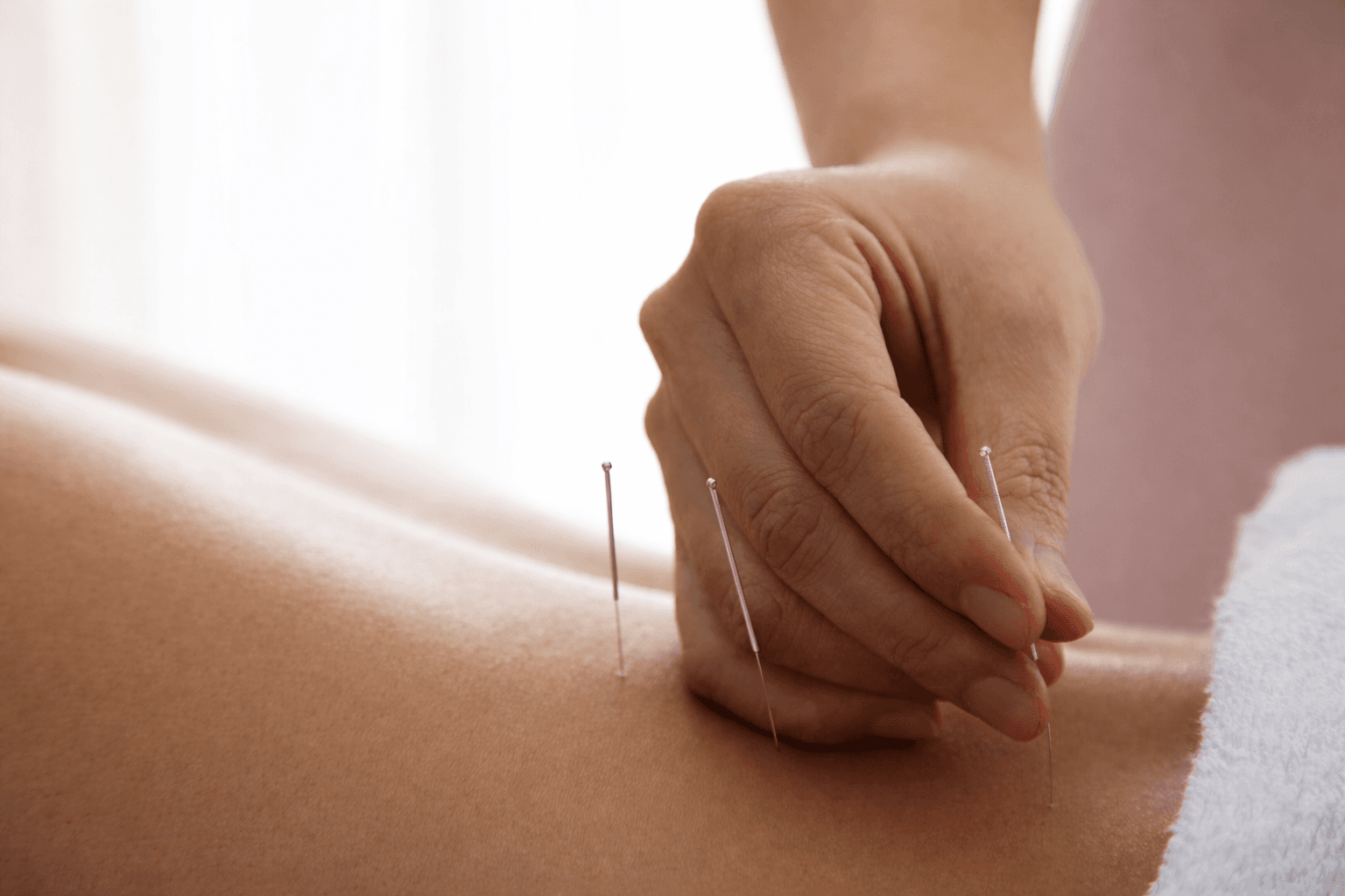 Lower back with 3 acupuncture needles