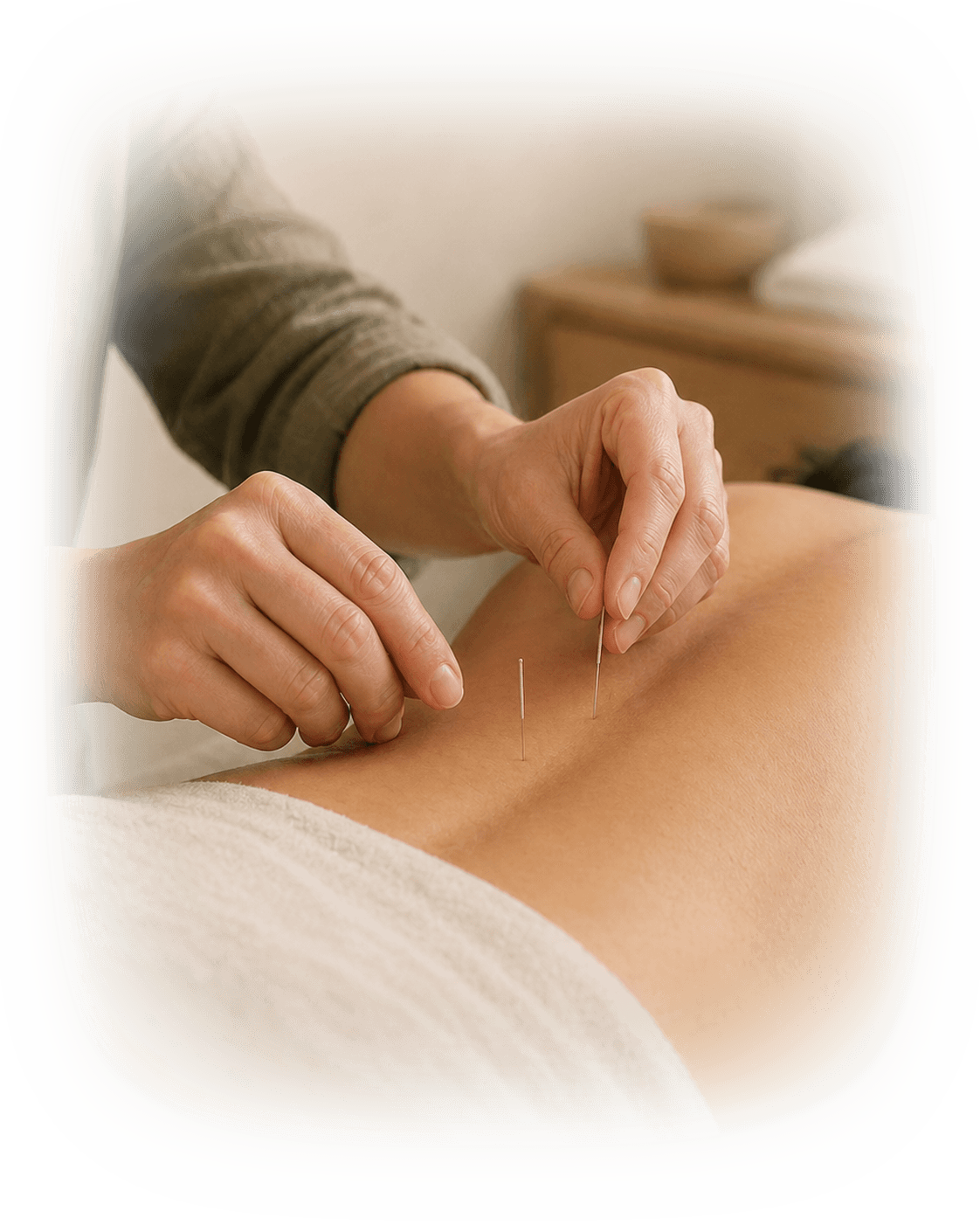 Practitioner placing acupuncture needles for chronic pain treatment